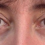 Men's Eye Lift Before & After Patient #1450