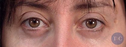 Men's Eye Lift Before & After Patient #1450