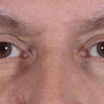 Men's Eye Lift Before & After Patient #1453