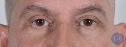 Men's Eye Lift Before & After Patient #1453