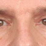 Men's Eye Lift Before & After Patient #1456