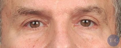 Men's Eye Lift Before & After Patient #1456