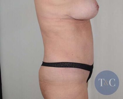 Tummy Tuck Before & After Patient #211
