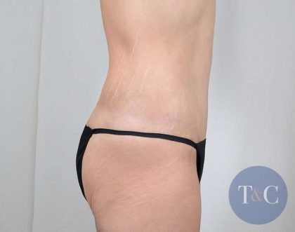 Tummy Tuck Before & After Patient #221