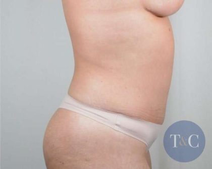 Tummy Tuck Before & After Patient #226