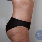 Tummy Tuck Before & After Patient #231