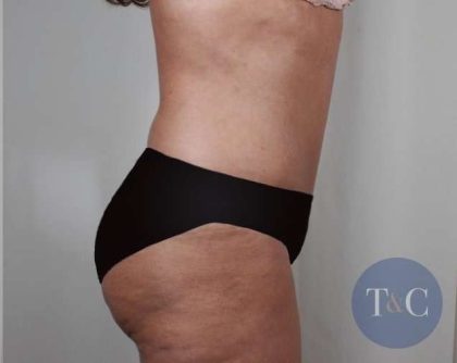 Tummy Tuck Before & After Patient #231