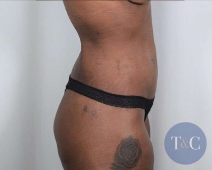 Tummy Tuck Before & After Patient #251