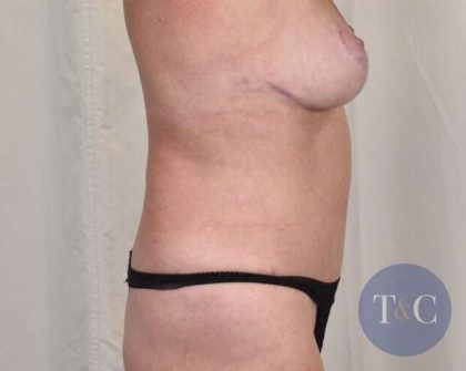 Tummy Tuck Before & After Patient #261