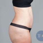 Tummy Tuck Before & After Patient #271