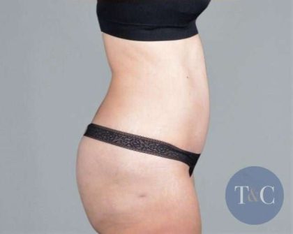 Tummy Tuck Before & After Patient #271