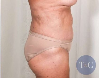 Tummy Tuck Before & After Patient #276