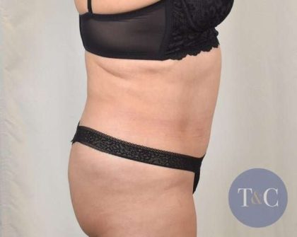 Tummy Tuck Before & After Patient #286
