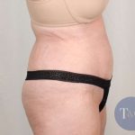Tummy Tuck Before & After Patient #291