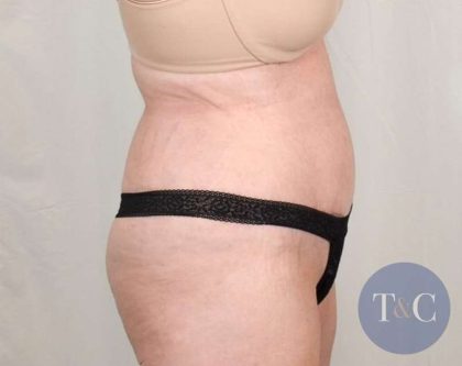 Tummy Tuck Before & After Patient #291
