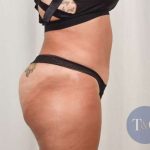 Tummy Tuck Before & After Patient #301
