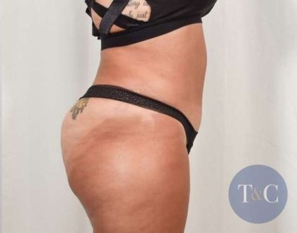 Tummy Tuck Before & After Patient #301