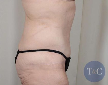 Tummy Tuck Before & After Patient #316