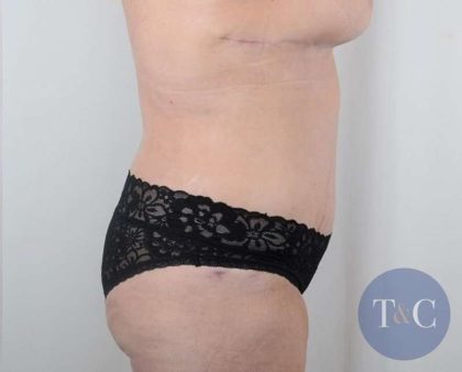 Tummy Tuck Before & After Patient #326