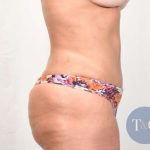 Tummy Tuck Before & After Patient #331