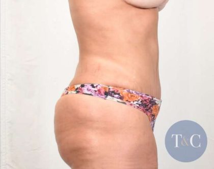 Tummy Tuck Before & After Patient #331