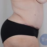 Tummy Tuck Before & After Patient #341