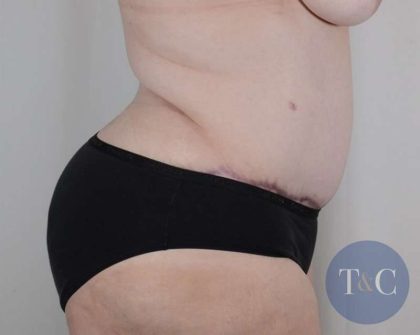 Tummy Tuck Before & After Patient #341