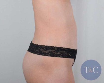 Tummy Tuck Before & After Patient #346