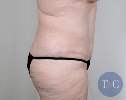 Tummy Tuck Before & After Patient #351