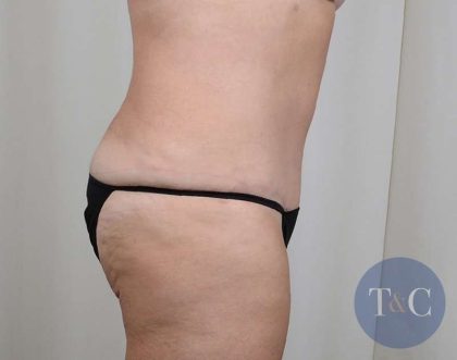 Tummy Tuck Before & After Patient #356