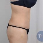 Tummy Tuck Before & After Patient #361