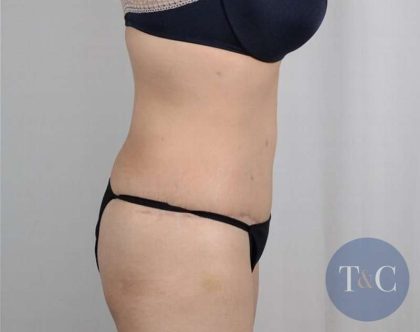 Tummy Tuck Before & After Patient #361