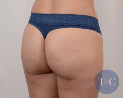 Brazilian Butt Lift Before & After Patient #413