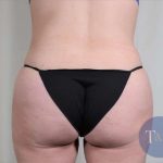 Brazilian Butt Lift Before & After Patient #418