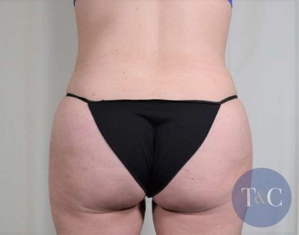 Brazilian Butt Lift Before & After Patient #418
