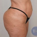 Brazilian Butt Lift Before & After Patient #423