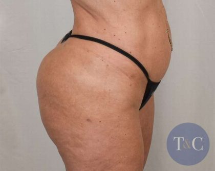 Brazilian Butt Lift Before & After Patient #423