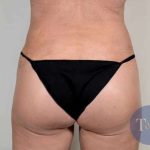 Brazilian Butt Lift Before & After Patient #428