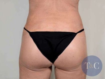 Brazilian Butt Lift Before & After Patient #428