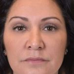 Liposuction Before & After Patient #438