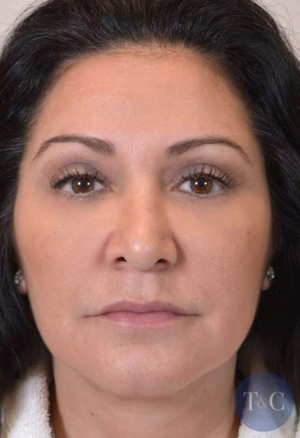 Liposuction Before & After Patient #438