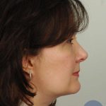 Liposuction Before & After Patient #441