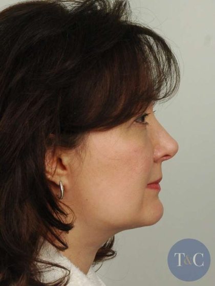 Liposuction Before & After Patient #441