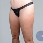 Liposuction Before & After Patient #448
