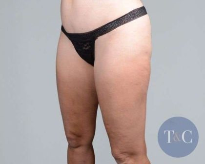 Liposuction Before & After Patient #448