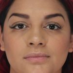 Liposuction Before & After Patient #458