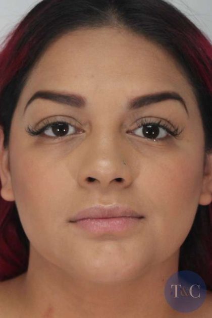 Liposuction Before & After Patient #458