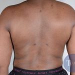 Liposuction Before & After Patient #483