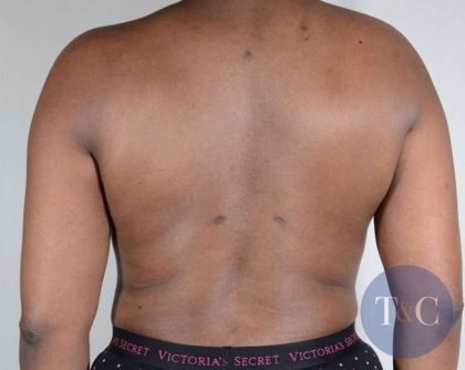 Liposuction Before & After Patient #483