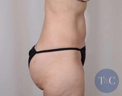 Liposuction Before & After Patient #491
